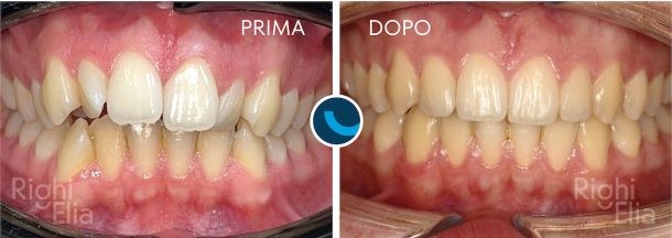 Caso documentato: Dentista Parma  - Righi Ambulatori Odontoiatrici