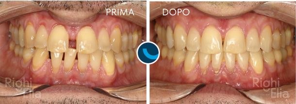 Caso documentato: Dentista Parma  - Righi Ambulatori Odontoiatrici