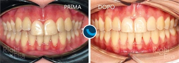 Caso documentato: Dentista Parma  - Righi Ambulatori Odontoiatrici